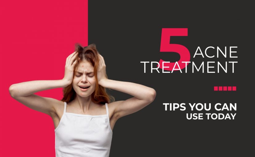 5 ACNE TREATMENT TIPS YOU CAN USE TODAY